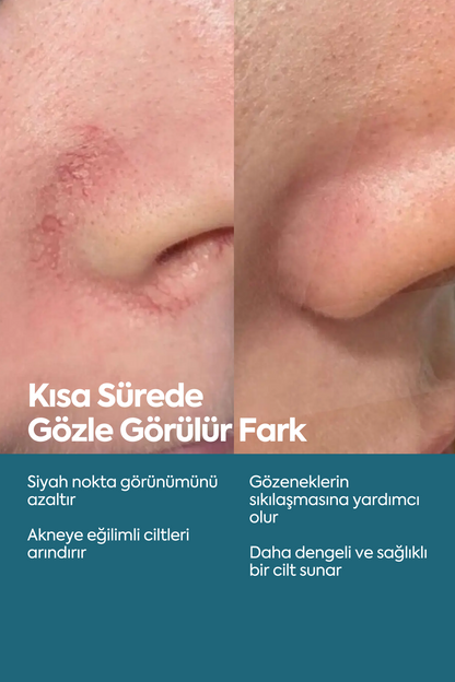 Siyah Nokta ve Akne Düşmanı - Anti Blackhead & Acne Serum 50 ml