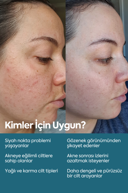 Siyah Nokta ve Akne Düşmanı - Anti Blackhead & Acne Serum 50 ml