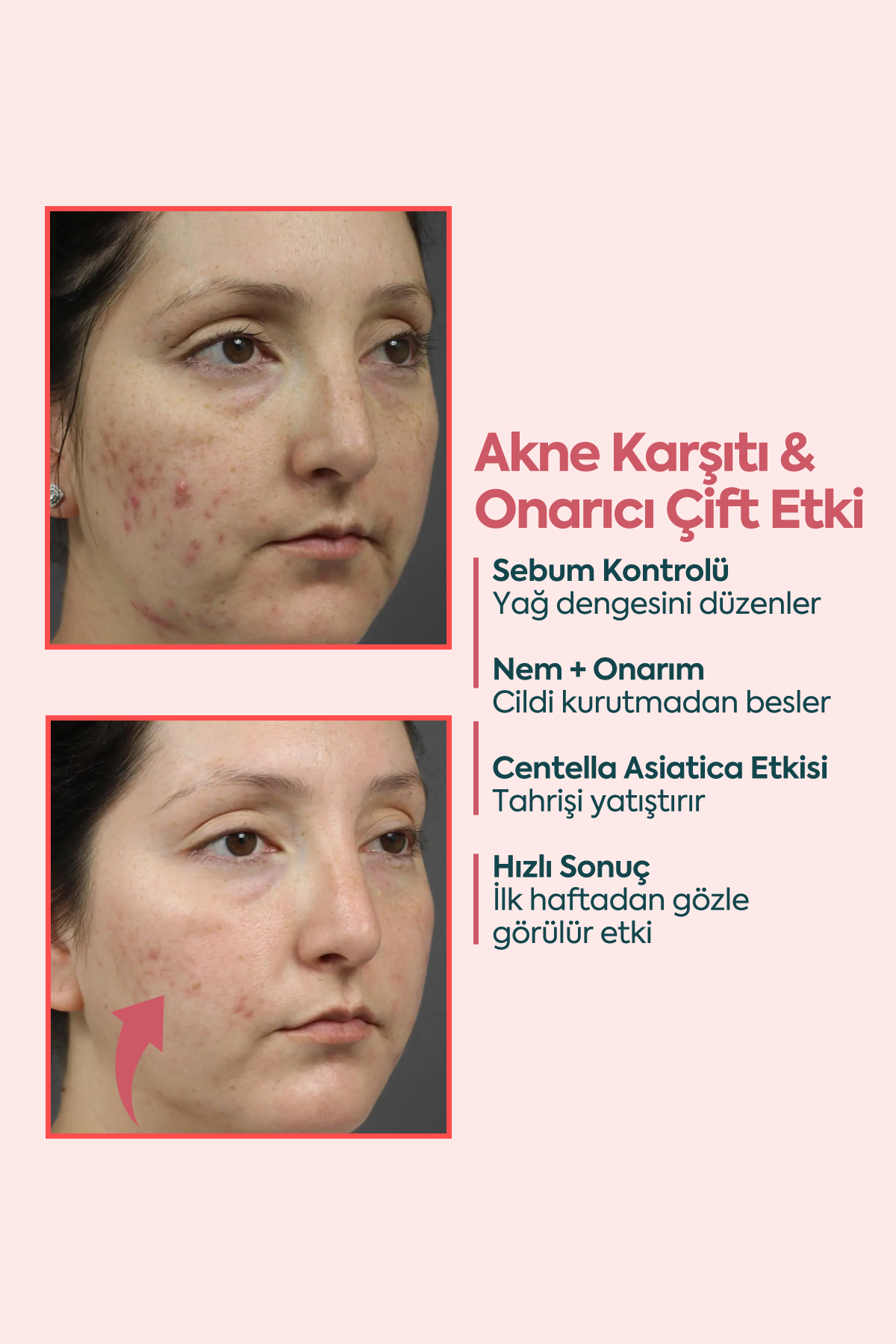 Akne ve Sivilceler için Mükemmel Etki - FACEUPSKIN® Acne Cream 40 ml