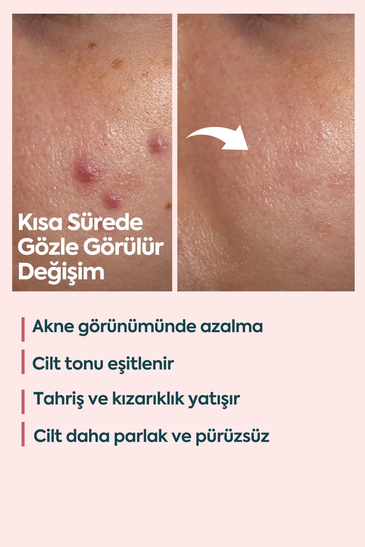 Akne ve Sivilceler için Mükemmel Etki - FACEUPSKIN® Acne Cream 40 ml